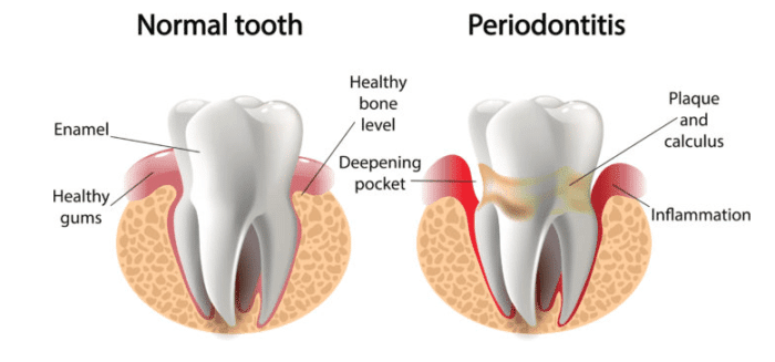 Bleeding gums treatment in Kanata and Ottawa Ontario