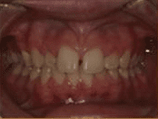 Before image of patient with dental needs
