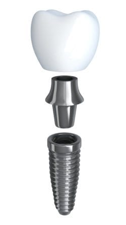 dental implants in Kanata, Ottawa, and Stittsville