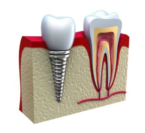 Dental Implants Resembling a Tooth, Showcasing Advanced Dental Solutions in Ottawa, ON