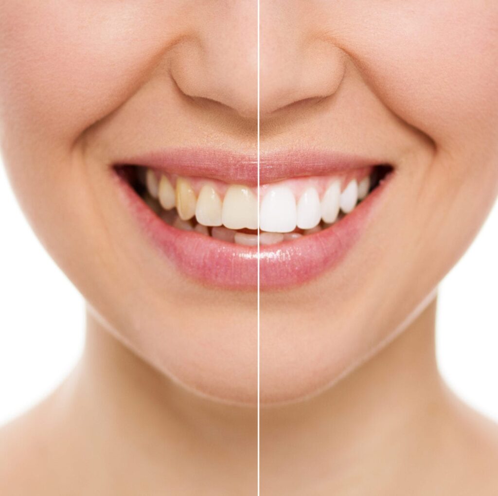 A Woman Showcasing Her Bright White Teeth Before and After a Whitening Treatment in Stittsville, ON