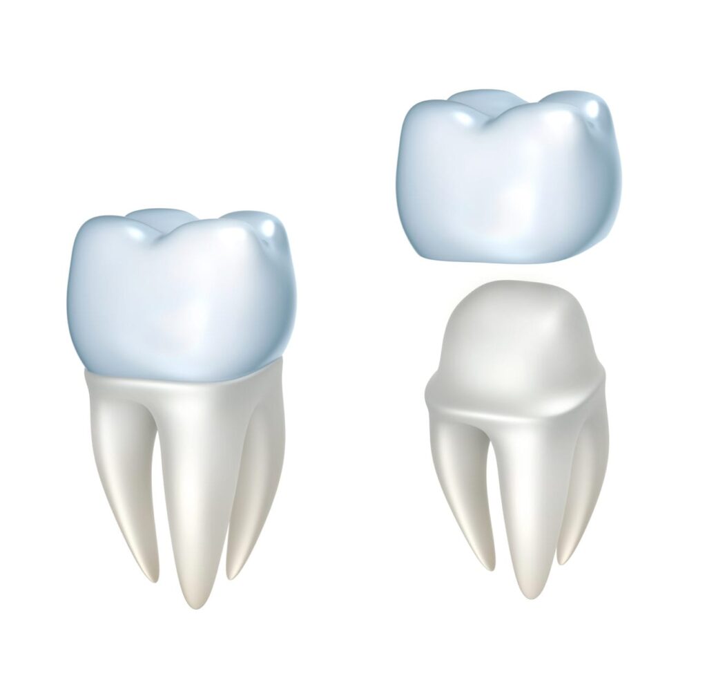 A Tooth and a Dental Crown Displayed Together, Affordable Dental Crown Options in Kanata, ON