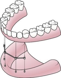 implant-secured dentures in Kanata, Ottawa, and Stittsville