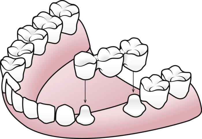 dental bridge in Kanata and Ottawa, Ontario