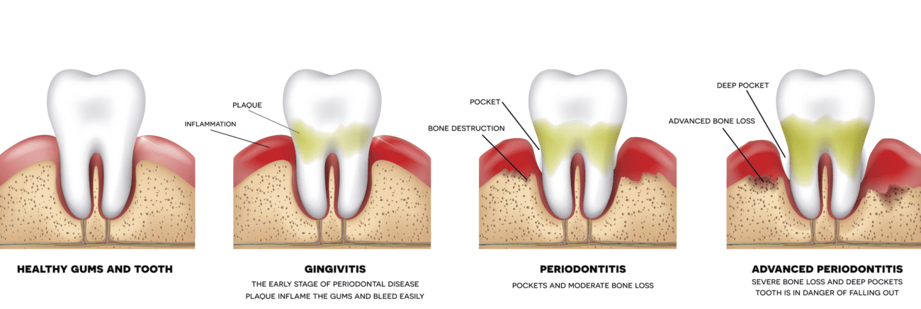 Periodontal Therapy in Kanata, Ottawa, Ontario