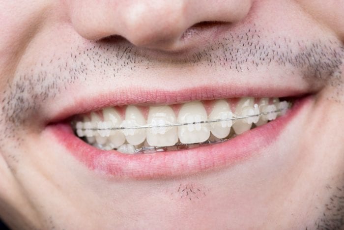 Invisible Adult Braces - Invisible Braces Ottawa