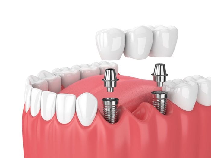dental implants tooth replacement in Stittsville Ontario