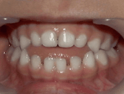 What is an open bite? What is an overbite? Can you have both at