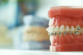 Traditional Metal Braces in Kanata and Ottawa, ON