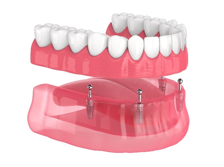 denture stabilization