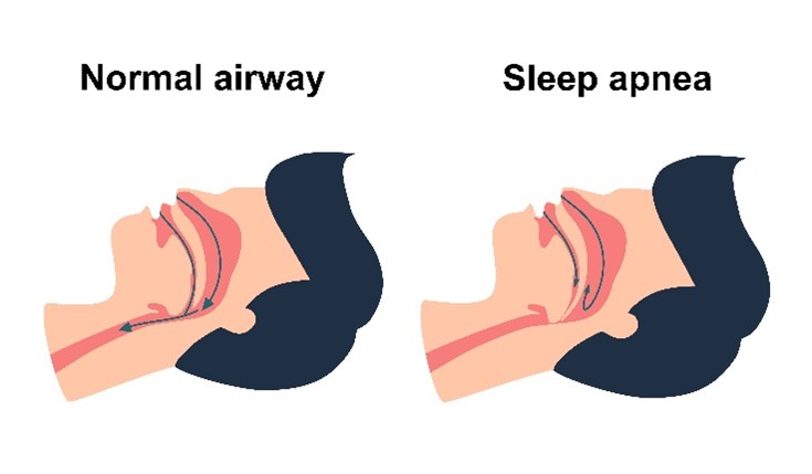 sleep apnea airways