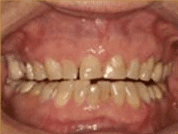The person's unaligned tooth in Villanova dental studio.