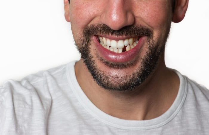 missing tooth replacement in Stittsville Ottawa