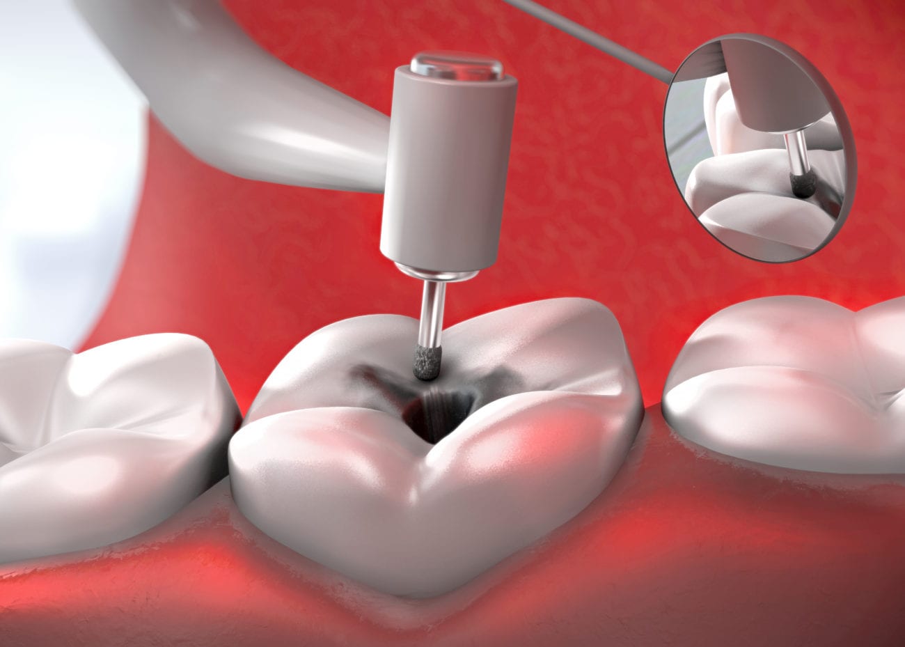 A animation of dentist's drill treating a sick tooth at Stittsville, ON