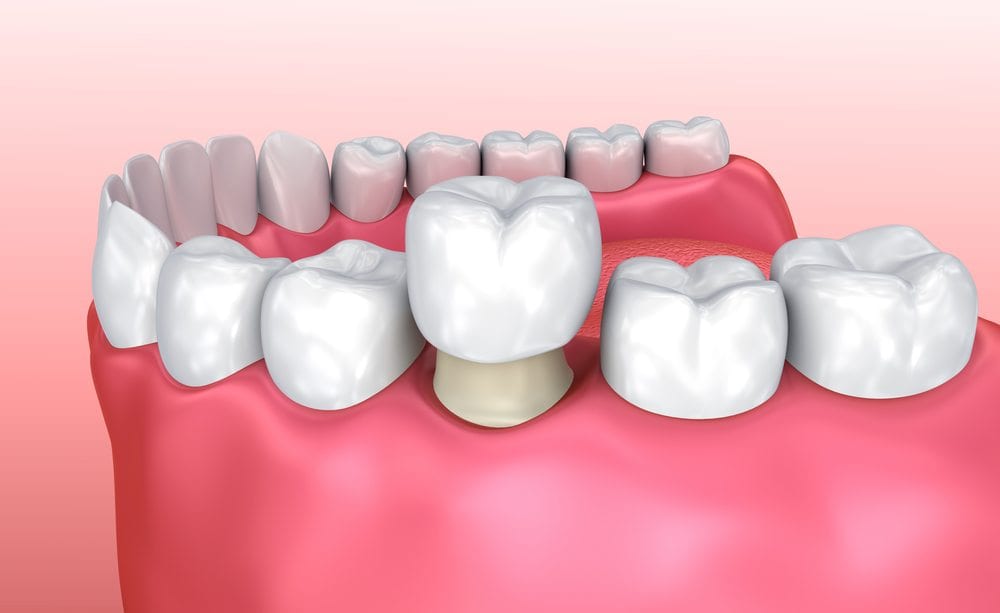 A animation of Dental Crowns in teeth at Stittsville, ON