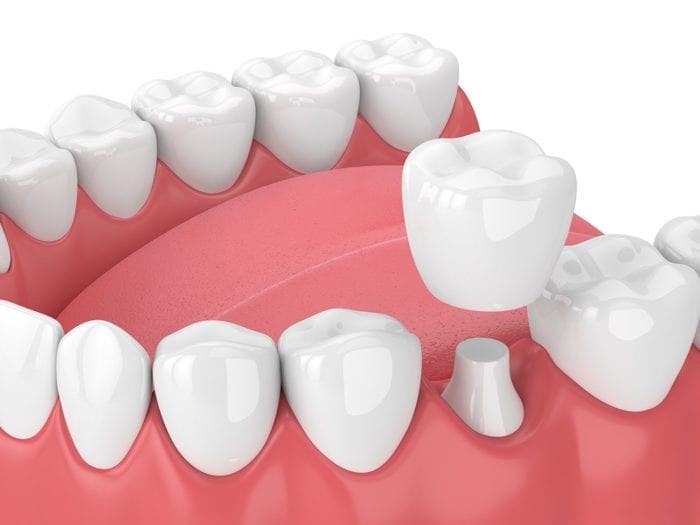 Dental crowns are a very common dental treatment
