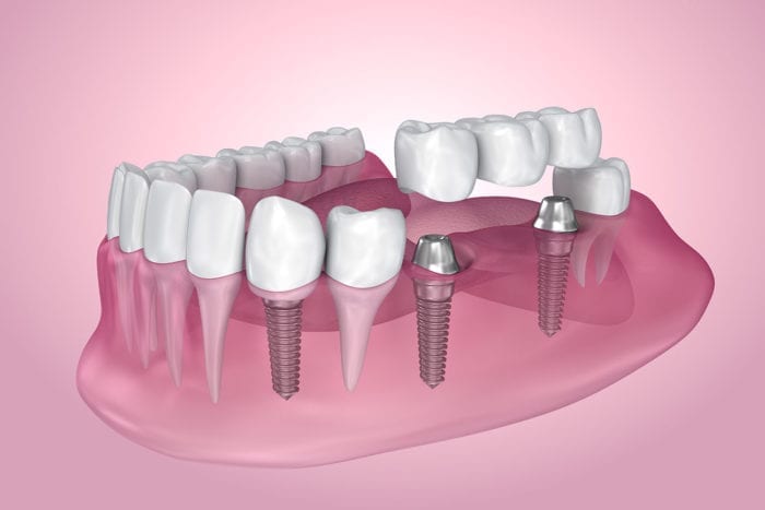 dental implants stittsville on