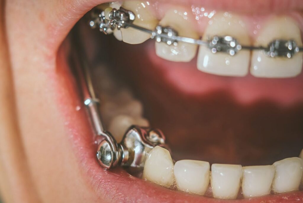 Benefits of two-phase orthodontic treatment for children in Kanata, ON