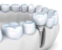 Dental Implants in Kanata ON
