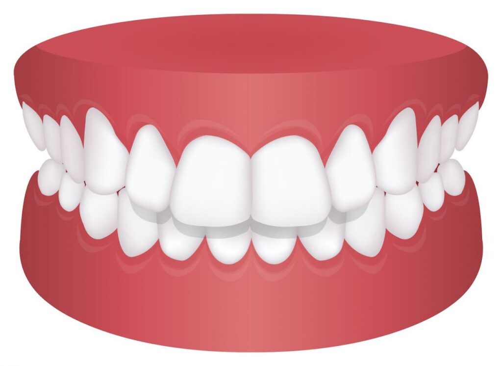 Illustration of a Human Jaw and Teeth, Specifically Depicting a Dental Condition fo Deep Bite