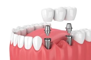 dental implants tooth replacement in Stittsville Ontario