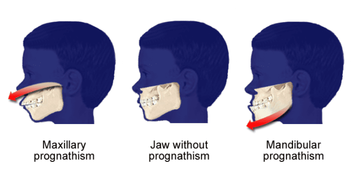 Underbite jaw protrusion