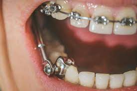 early orthodontic treatment in Katana and Ottawa Ontario