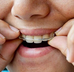 Exploring Various Orthodontic treatment Topics