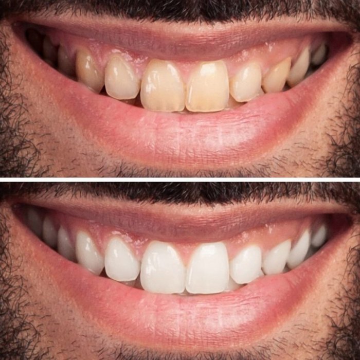 Teeth Whitening Before After Result