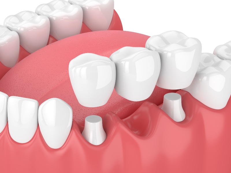 3D illustration of a dental bridge supported by implants replacing missing teeth for restorative dentistry in Kanata and Stittsville, ON