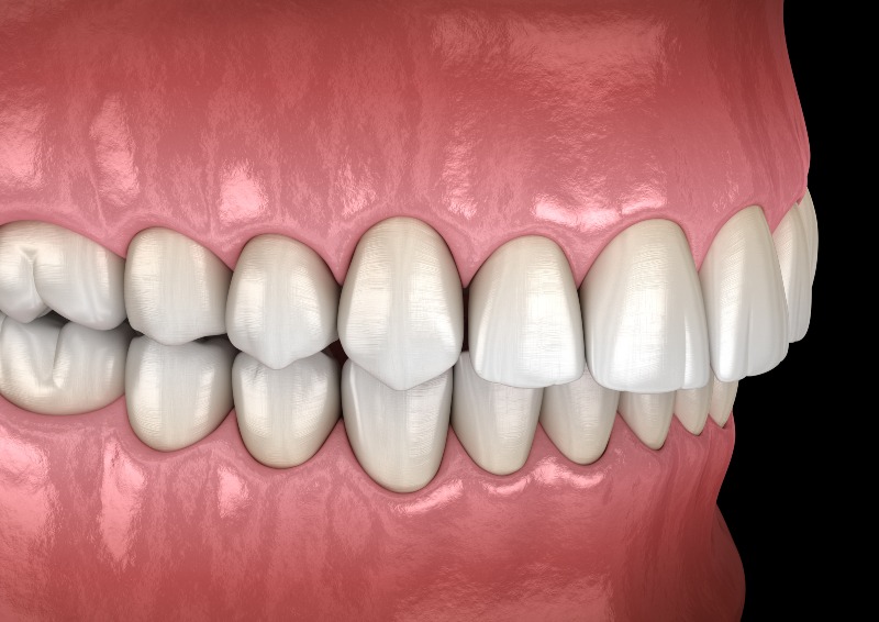 3D illustration of teeth alignment showing overbite, underbite, and bite positioning for orthodontic evaluation in Kanata and Stittsville, ON
