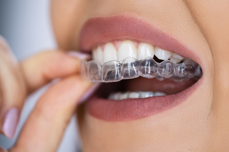Person inserting clear Invisalign aligners to straighten teeth and improve smile alignment in Kanata and Stittsville, ON